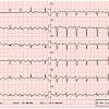 Pvst symptoms include weakness, shortness of breath, chest pressure, lightheadedness, and palpitations. 1