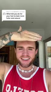 Amazing Hair Transplant Results After Four Months!