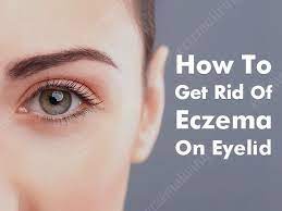 Eyelid Dermatitis How To Get Rid Of Eczema On Eyes Eczema On Eyelids Get Rid Of Eczema Eyelid Dermatitis