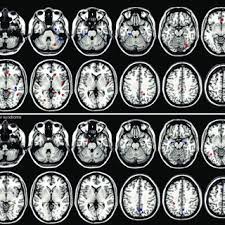 However, they tend to play, learn, speak, and. Pdf Can Asperger Syndrome Be Distinguished From Autism An Anatomic Likelihood Meta Analysis Of Mri Studies