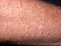 Image result for Pigment stains on the shin