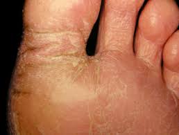 From the irritation of tight or stuffy shoes to direct contact with contaminated surfaces in some cases, dry skin may have an underlying medical cause, but some people just have naturally dry skin. Juvenile Plantar Dermatosis Dermnet Nz