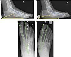 Charcot fuß diabetischer fuß frühstadium. Die Rolle Der Radiologischen Bildgebung Beim Charcot Fuss Sciencedirect