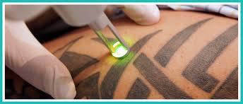 The number of required treatments is based on the tattoo's age, size, type, and pigment depth. Laser Tattoo Removal Shining Light On A Flourishing Industry