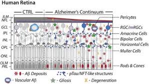 54 reviews from retina associates employees about retina associates culture, salaries, benefits retina associates is an exceptional company to work for. Frontiers Alzheimer S Retinopathy Seeing Disease In The Eyes Neuroscience