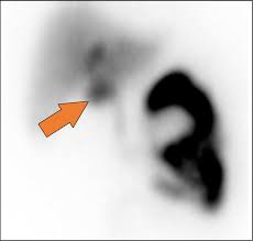 Image result for HIDA Scan