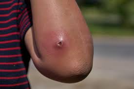 Image result for Skin Abscess