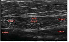 Misdiagnosing Abdominal Myofascial Pain Syndrome As Anterior Cutaneous Nerve Entrapment Syndrome Are We Failing Patients With Nonspecific Abdominal Pain Semantic Scholar