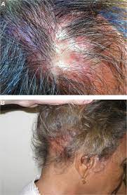 Frontal fibrosing alopecia (ffa) is a form of lichen planopilaris that is characterized primarily by slowly progressive hair loss (alopecia) and scarring on the scalp near the forehead. Lichen Planopilaris Notes A Lichen Planopilaris Note The Striking Download Scientific Diagram