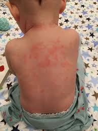 Image result for sweat rash on back baby