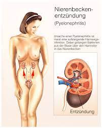 Sie entsteht meist durch das aufsteigen von bakterien durch die harnleiter und kann somit folge einer unbehandelten. Nierenbeckenentzundung Pyelonephritis Symptome Behandlungen