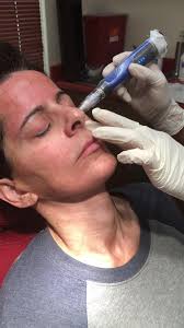 Microneedling treatment