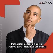 Implante Capilar de outra pessoa: posso usar? Dr. Armando Cunha