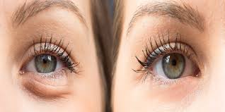 Good eye hygiene, including removing makeup at night and keeping the eyes clean by wiping the closed eyes with a clean, warm washcloth, can help reduce the eye discharge. Is Eyelid Surgery Right For Me Rt Aesthetics Newcastle