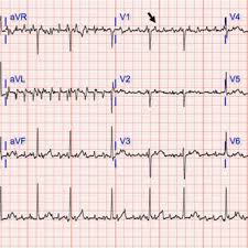 12 lead normal sinus rhythm ekg. Repeat 12 Lead Ekg Showing Normal Sinus Rhythm Download Scientific Diagram