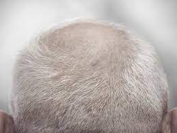 Pulling a hairbrush through wet hair can create more tension and can end up snapping the hair. Pulling Your Hair Out It Might Just Help Reverse Baldness Science Smithsonian Magazine