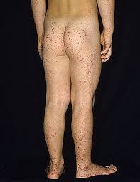 The spots can develope on various parts of the body, particularly on face, chest, back, arms and legs. Henoch Schonlein Purpura Wikipedia