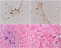 Murine models of enteroviral myocarditis suggest viral myocarditis is characterized by 3 phases. Diagnosis Of Myocarditis Current State And Future Perspectives International Journal Of Cardiology