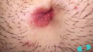 Image result for Impetigo