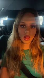 broken ankle #sydney #09 #fyp #viral