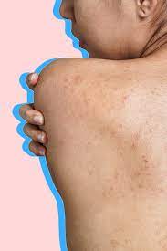 We've compiled a list of home and medical remedies to help you clear up your skin and get rid of back acne scars. How To Get Rid Of Acne Scars According To Dermatologists Popsugar Beauty