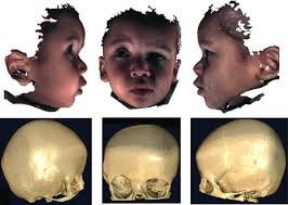Genetic analysis of non-syndromic craniosynostosis