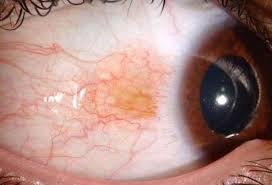 Image result for nevus sclerae