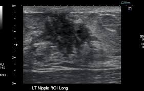 Can ultrasounds miss breast cancer? Breast Pathology Ultrasound