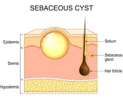 Image result for Sebaceous Gland