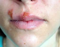 Herpes infections are very common. Herpes Simplex Newnan Cold Sores Peachtree City Fever Blisters Lagrange