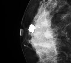 That makes it easy to detect abnormalities, which generally show up as white. Mammogram Images Normal Abnormal And Breast Cancer