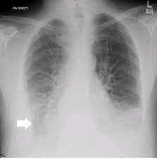 Pleural effusion develops when more fluid enters the pleural space than is removed. Cureus Constrictive Pericarditis Presenting As Bilateral Pleural Effusion A Report Of Two Cases