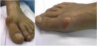 Hallux Rigidus Foot And Ankle Institute Bone Spurs Plantar Fasciitis Remedies Foot Remedies