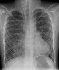 Image result for Protein C Deficiency