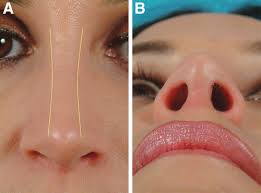 To contour your nose, start by using a small brush and some bronzer to draw contour lines from your brow bone to the bottom of your nose. Nasal Tip Contouring Anatomic Basis For Management Facial Plastic Surgery Aesthetic Medicine