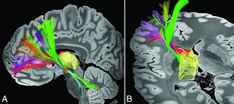 Image result for Thalamic Stimulation