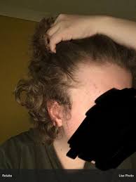 Is My Hairline Receding I M 15 And Scared Hairloss