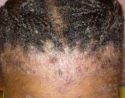 Seborrheic dermatitis is an inflammatory skin condition that occurs as a result of a particular yeast on the skin. Dermatitis Treatments In Atlanta Hair Loss Treatment Clinic Nina Ross Atlanta Trichology