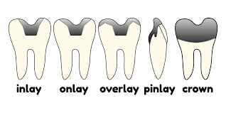 This Is The Difference Between Dental Crown Dental Cap Inlay Overlay Onlay And Pinlay They Are All Used To Restore A Dama Dental Crowns Dental Caps Dental