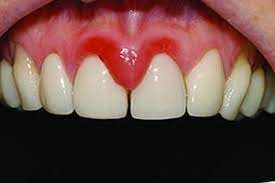 Signs and symptoms of gingivitis include Gum Disease