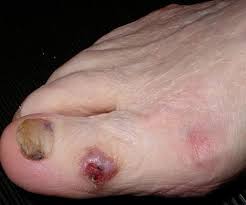 Most often a black spot that looks like you dropped something on your toe is an old hemorrhage from trauma. Basal Cell Carcinoma On The Toe