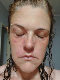 Treatment for yeast rash from silicone mask?