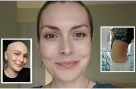 Mėnesius ignoravau "nekenksmingą" pilvo pūtimą, kol buvo per vėlu