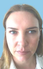 Katrina Has A Non-Surgical Facelift with PDO Threads