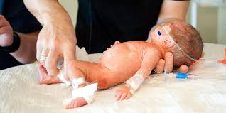 Image result for diaper dermatitis