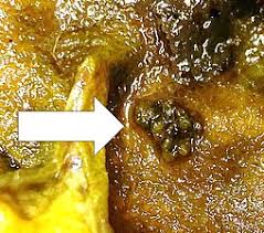 Nume generic dat animalelor celenterate de forma unui săculeț și cu gura înconjurată de tentacule, care trăiesc fixate. Gallbladder Polyp Wikipedia