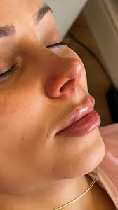 O Endolit é um laser de última geração utilizado no tratamento facial,  promovendo rejuvenescimento e melhoria na qualidade da pele. Através de  tecnologia avançada, ele estimula a produção de colágeno, reduz rugas,