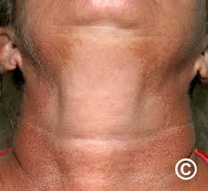 Image result for Diffuse Hyperpigmentation