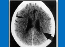 Nodul la san / cancer mamar. Noua Medicina Germana Dr Ryke Hamer