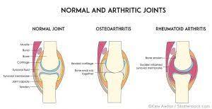Was Ist Der Unterschied Zwischen Arthrose Und Arthritis Unterschied